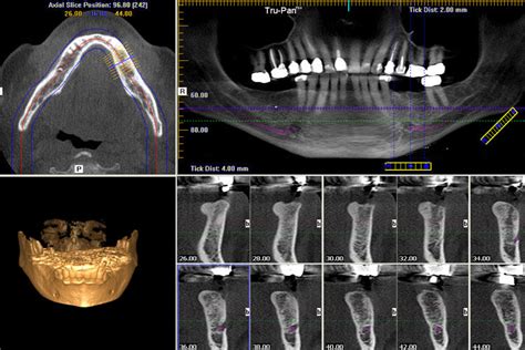 Cone Beam Ct