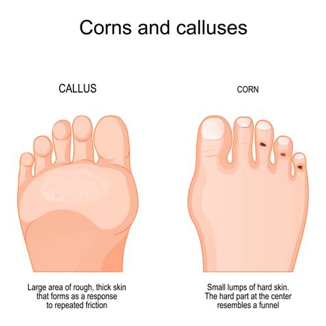 Corn Or Callus Difference