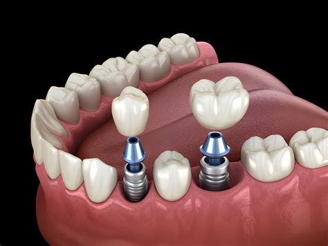 Crowns And Implants Dentistry