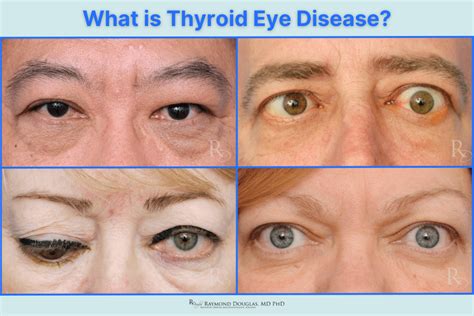 Cure Thyroid Eye Disease