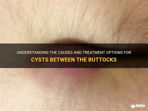 Cyst Inside Buttock