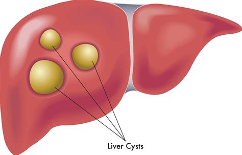 Cyst On Liver