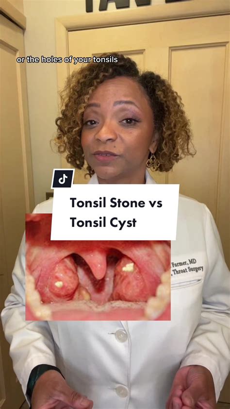 Cysts On Tonsils