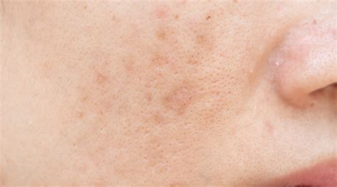 Dark Spots In Cheeks
