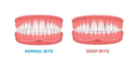 Deep Bite Vs Overbite