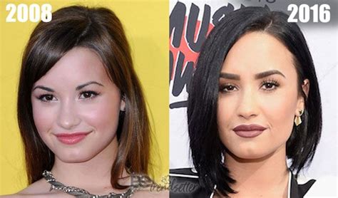 Demi Lovato Face Surgery