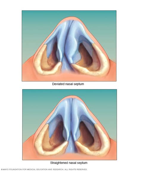 Deviated Septum Pictures