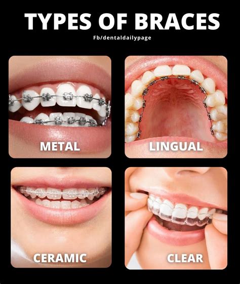Different Types Of Braces