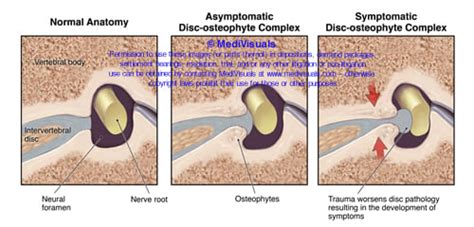 Disc Osteophyte Complex