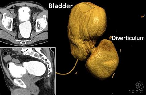 Diverticulum On Bladder