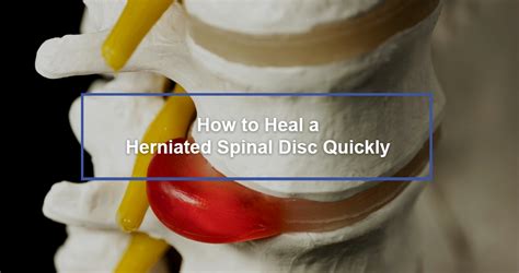 Do Herniated Discs Heal
