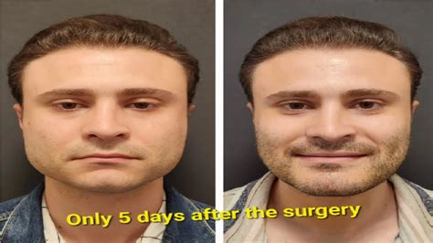 Does Jaw Surgery Change Your Face