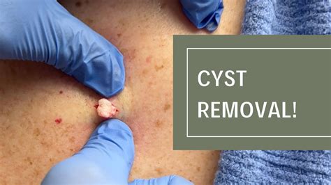 Dr To Remove Cyst