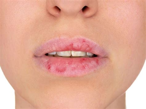 Dry Cracked Lips