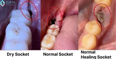 Dry Socket Images
