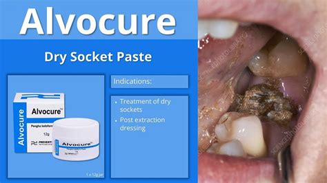 Dry Socket Paste