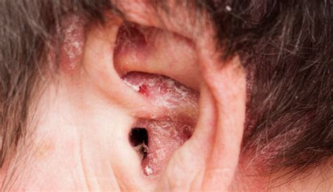 Ear Eczema Treatment