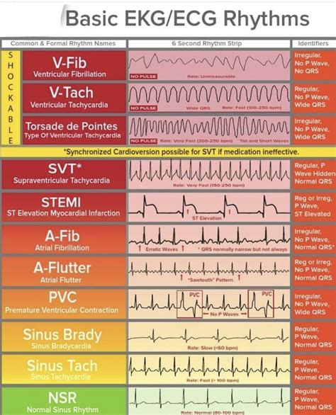 Ecg Rhythms