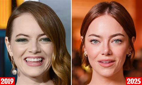 Emma Stone Face Surgery