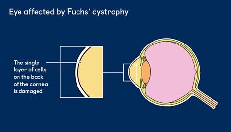 Eye Drops For Fuchs Dystrophy