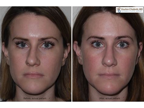 Face Before And After Sinus Surgery