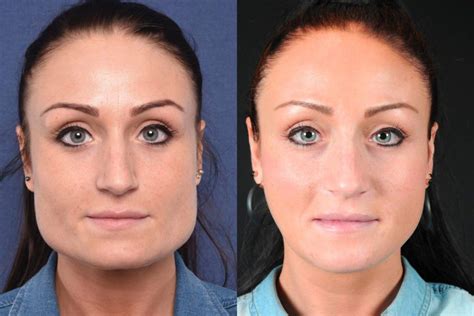 Face Shape Surgery