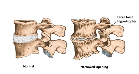 Facet Joint Hypertrophy