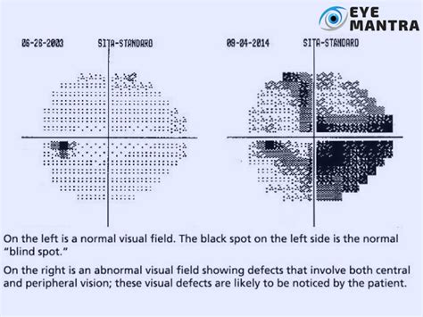 Field Vision Test