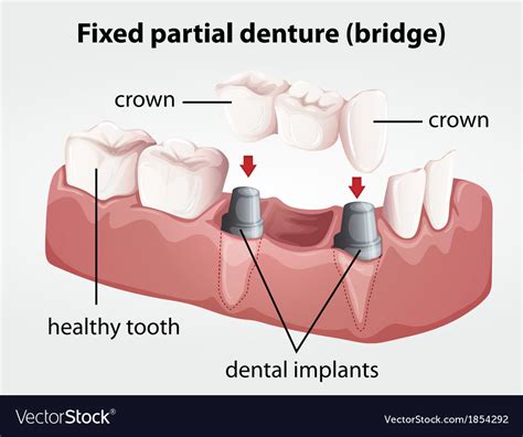 Fixed Partial Denture