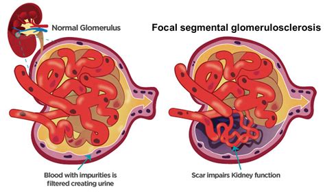 Focal Segmental Glomerular