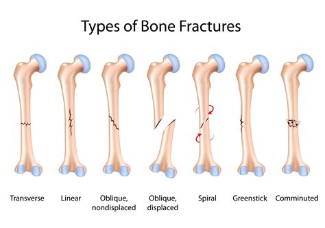 Fracture Broken Bone Difference