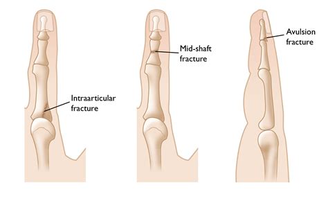 Fractured Finger Symptoms