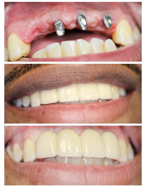 Front Dental Implants