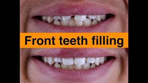 Front Tooth Filling
