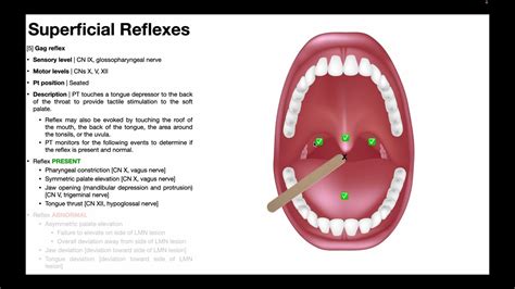 Gag Reflex Meaning