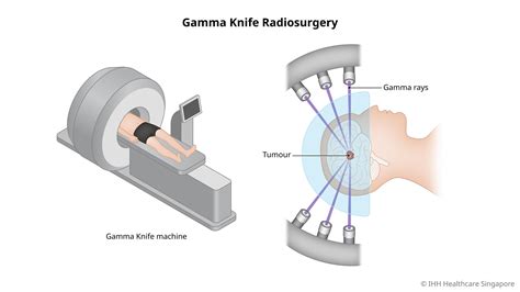 Gamma Knife Radiation