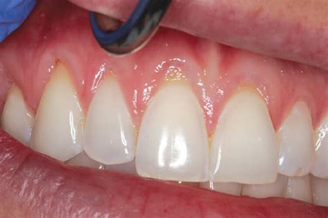 Gingival Recession Selfcare
