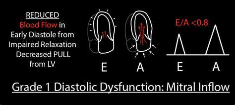 Grade 1 Diastolic Dysfunction