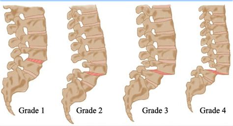 Grade 1 Spondylolisthesis