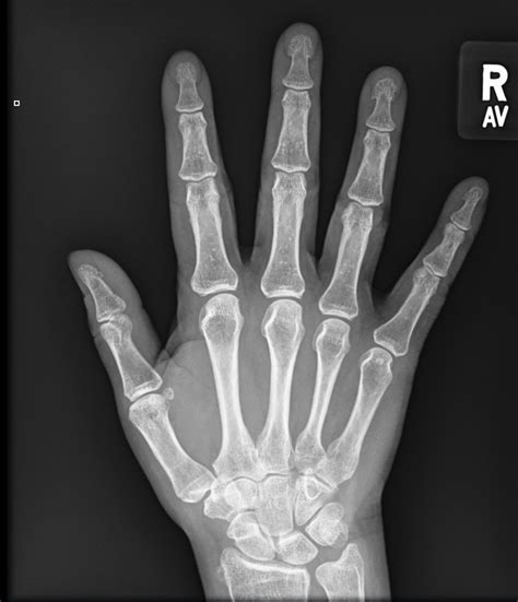 Hand X Ray