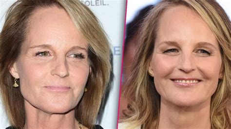 Helen Hunts Face Surgery