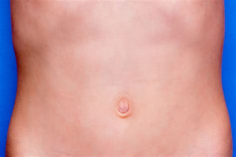 Hernia Belly Button