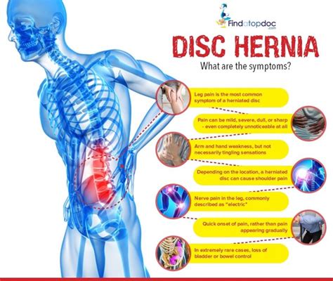 Herniated Disk Symptoms