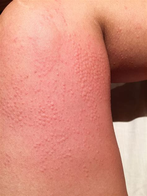 Hives From Cold
