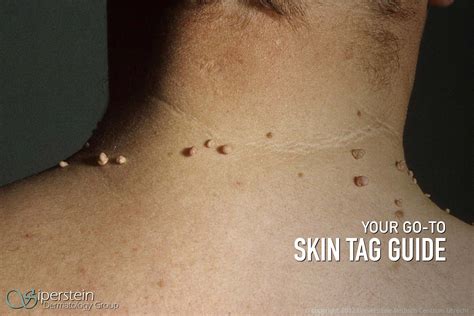 How Does Skin Tags Appear