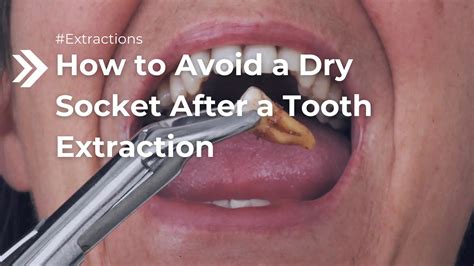 How To Avoid Dry Socket