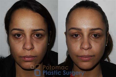 How To Decrease Swelling In Face After Surgery