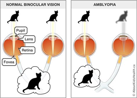 How To Fix Amblyopia