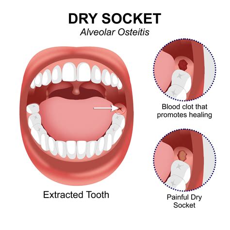 How To Get Dry Socket