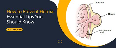 How To Prevent Hernia